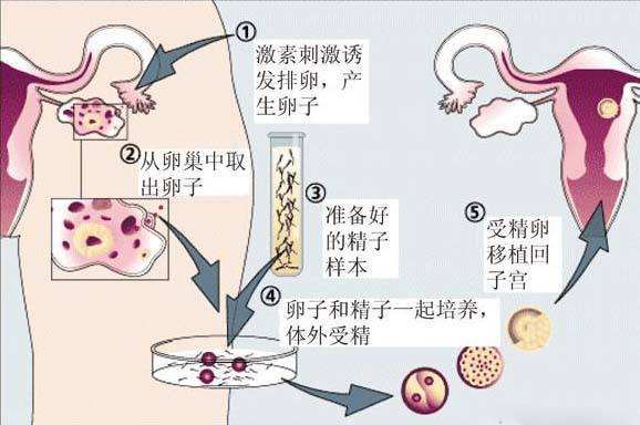 精子达到什么标准可以做借卵试管
