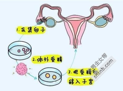 早衰赠卵试管用什么方案