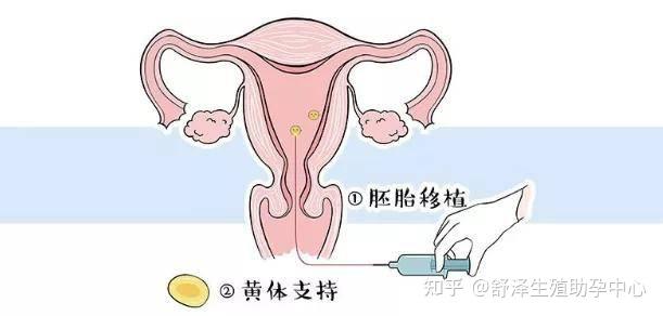 上海妇幼保健院试管婴儿流程