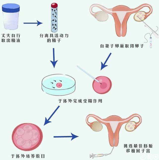 如何做试管婴儿怀龙凤胎
