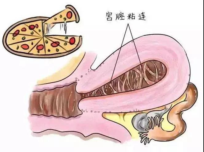 「多囊卵巢」引起多囊卵巢综合症的4大原因,80%的女性都不知道!